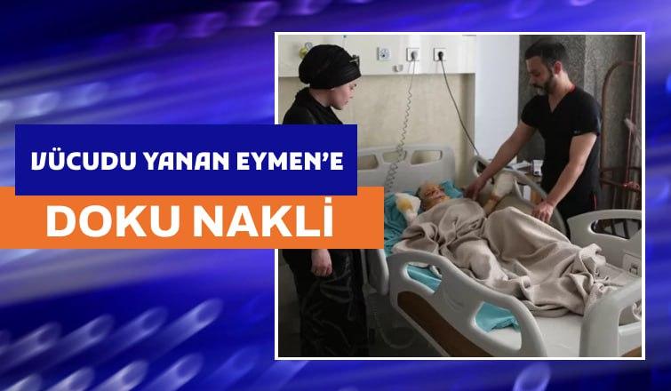 Vücudu Yanan Eymen'e Doku Nakli